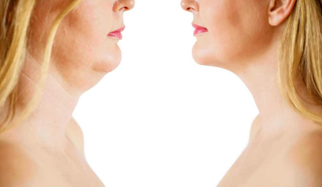 Double Chin treatment Greater London (Bexley) before and after results