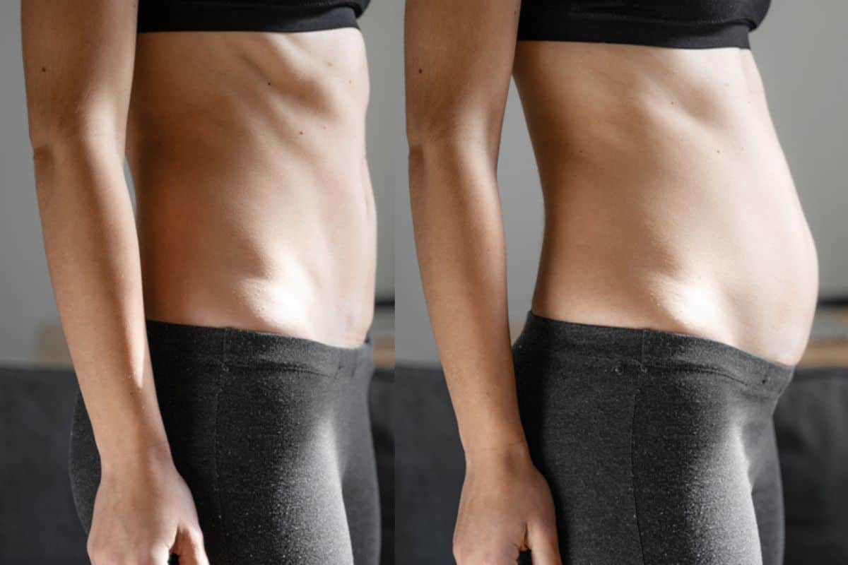 How long does diastasis recti take to improve Greater London (Bexley)?