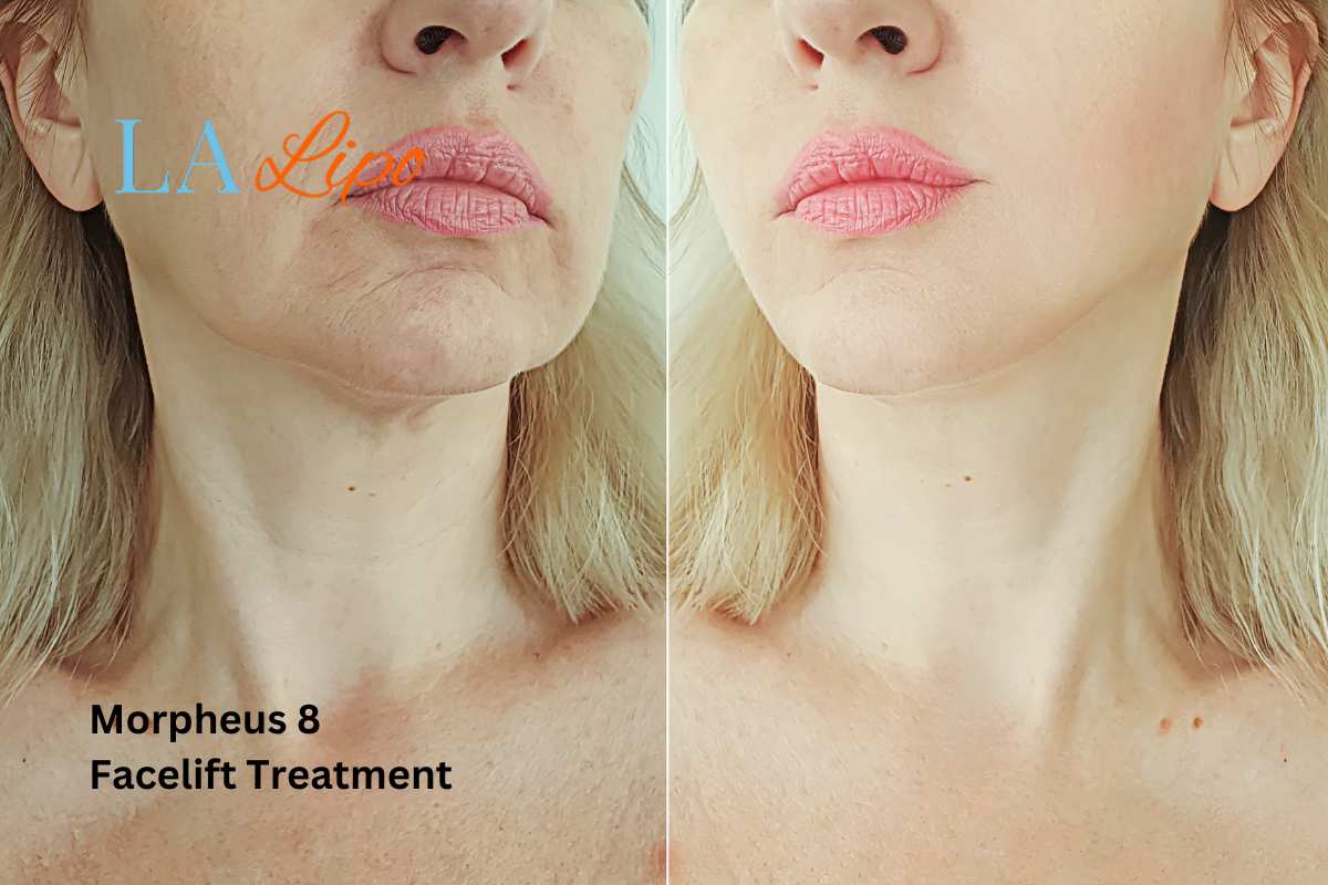 Turn back time with Morpheus8 Treatment Greater London (Bexley)