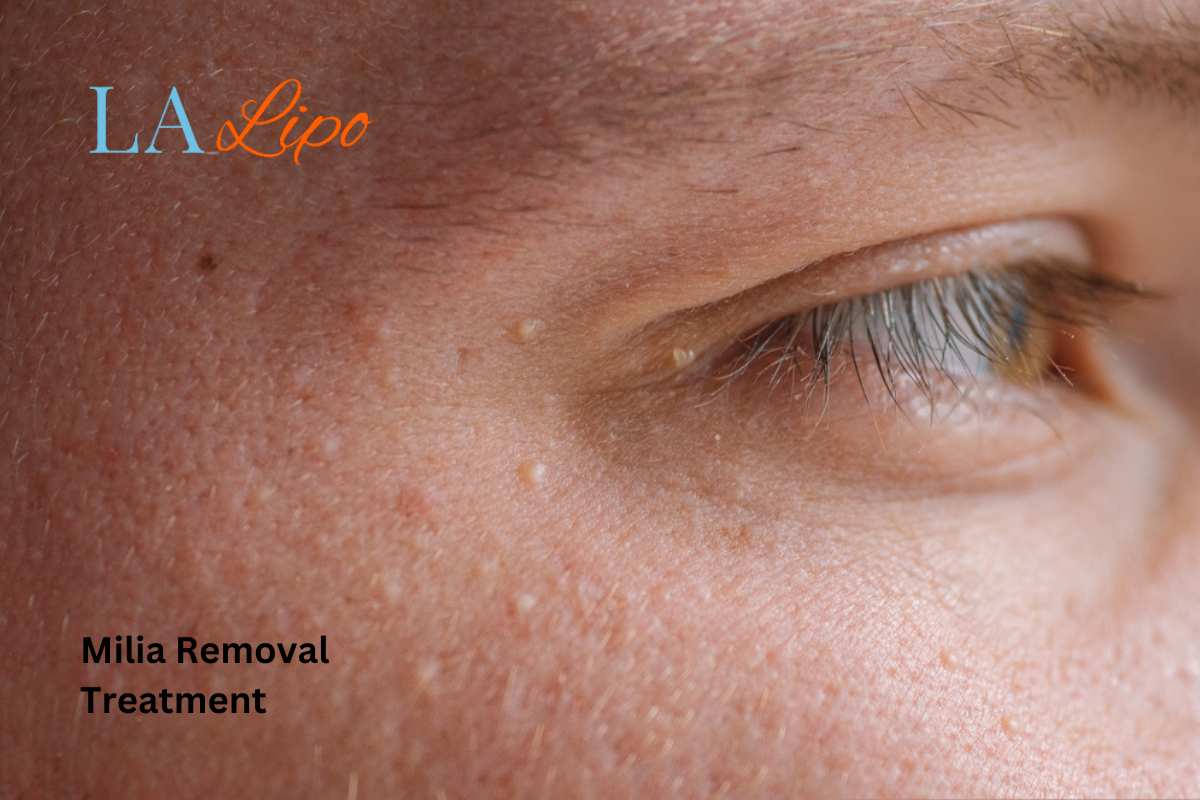 Cryopen Milia Removal: Is It the Easiest and Safest Option Greater London (Bexley)?