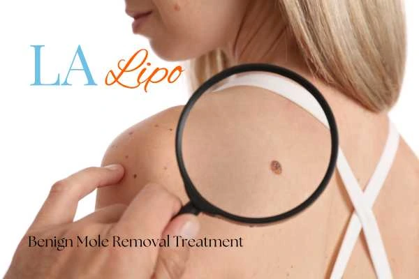 Why getting moles removed Greater London (Bexley) can boost your confidence!