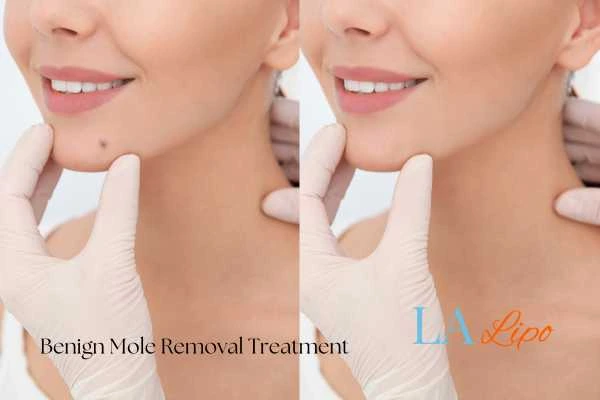 Woman's before and after results of being moles removal treatment Greater London (Bexley)