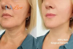 hi-fu for wrinkles Greater London (Bexley) before and after results