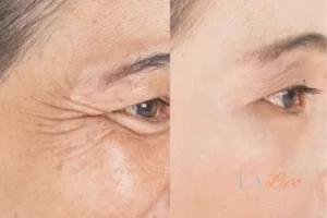 Before and after results of woman - HI-fu wrinkles reduction treatment Greater London (Bexley)
