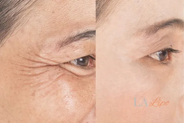 Before and after results of woman - HI-fu wrinkles reduction treatment Greater London (Bexley)