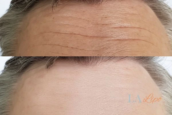 results of HIFU Greater London (Bexley) on mans forehead to help reduce lines and wrinkles