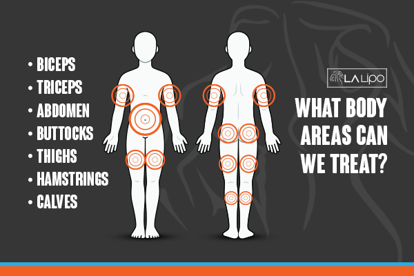 Graphic to show areas you can have LA-EMS Body Sculpting Greater London (Bexley) treatment.