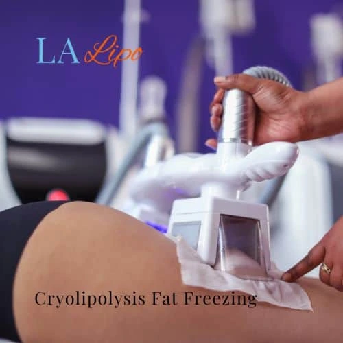 fat freezing - Cryolipolysis Greater London (Bexley)