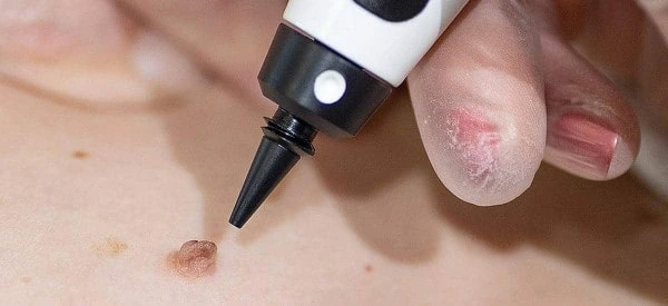 skin tag removal using cryopen Greater London (Bexley)