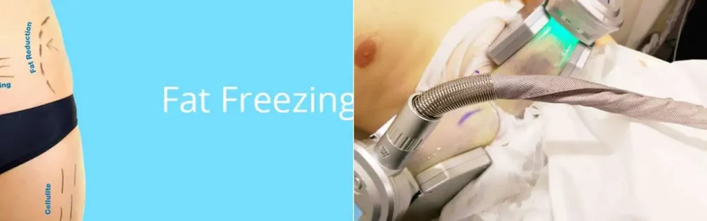 multi areas of a persons body having coolsculpting Greater London (Bexley) treatment