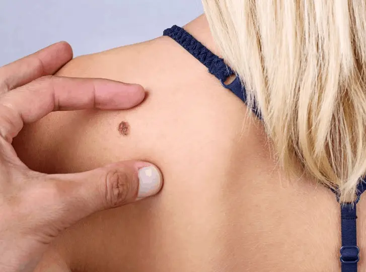 woman having mole removal Greater London (Bexley) consultation before treatment.