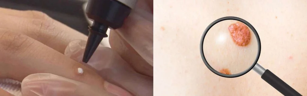 Person getting moles removed with cryopen Greater London (Bexley)