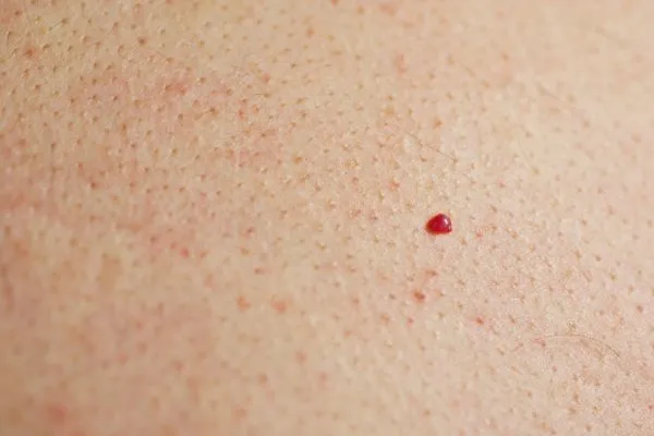 close up of a cherry angioma Greater London (Bexley)