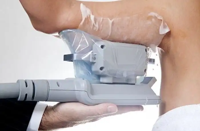 Picture of fat freezing Greater London (Bexley) on the upper arms.
