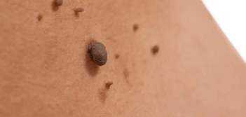 image of a skin tag Greater London (Bexley)