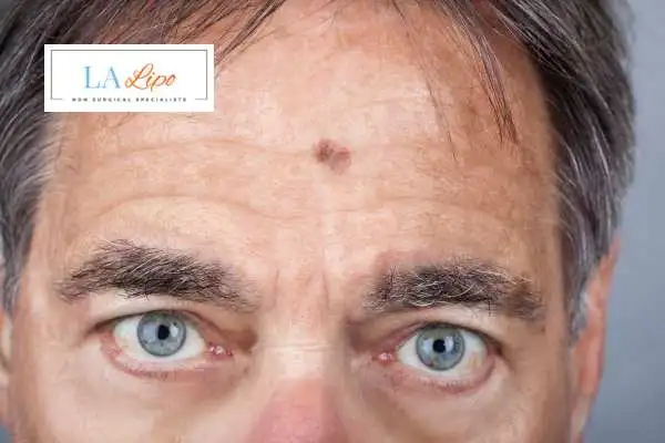 Solar Lentigo Removal Greater London (Bexley) image of man with mark on his forehead