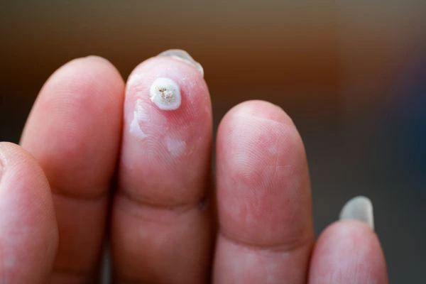 wart on person finger - cryotherapy to treat from LA LIPO Greater London (Bexley)
