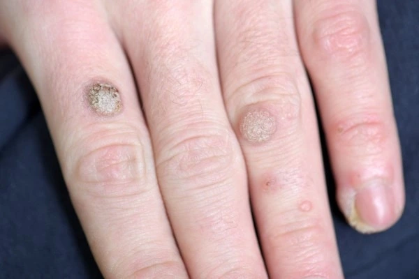 photo of warts on person hand - see wart removal Greater London (Bexley) from LA LIPO