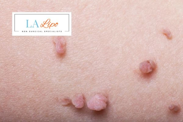 Does cryopen skin tag removal Greater London (Bexley) hurt? Find out now call our team today!