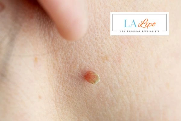 Book skin tag removal Greater London (Bexley) today speak to our team now!