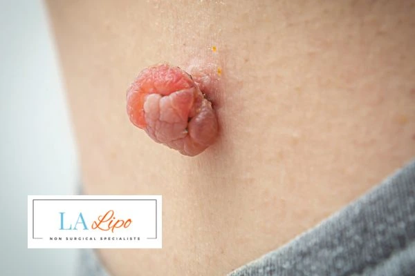 Interested in skin tag removal Greater London (Bexley)? Concerned about the pain? Find out more today!