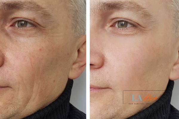 See the amazing results of Morpheus8 Treatment Greater London (Bexley)!