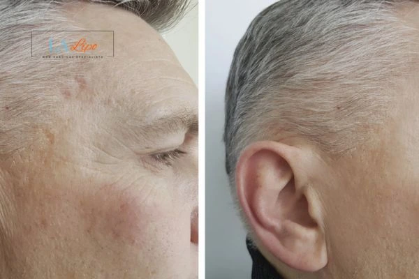 Mens Before & After Morpheus 8 Results Greater London (Bexley)