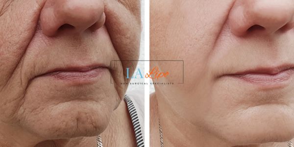 Older lady deeper wrinkle reduction - LA LIPO Morpheus 8 Results Greater London (Bexley)