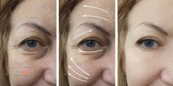 Amazing eye lift Morpheus 8 results Greater London (Bexley)