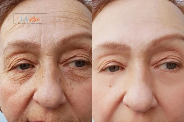 The powerful benefits of Morpheus8 Treatment Greater London (Bexley) - Call Our team today!