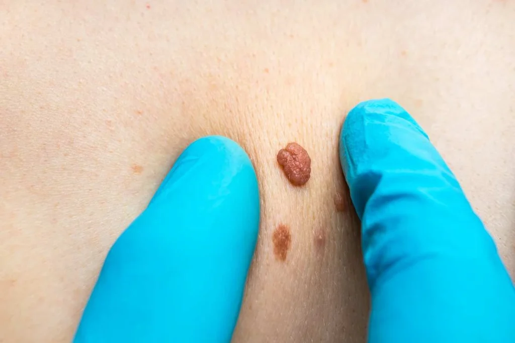 LA LIPO Cryopen Lesion Removal Prices Greater London (Bexley)