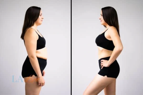 Picture of womans before and after using LA-EMS body sculpting to improve her core strength Greater London (Bexley)