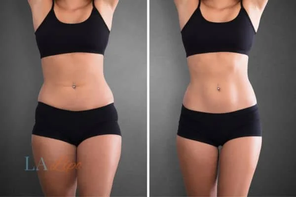 before and after results of non-surgical treatment to help a woman's body image and mental health Greater London (Bexley)