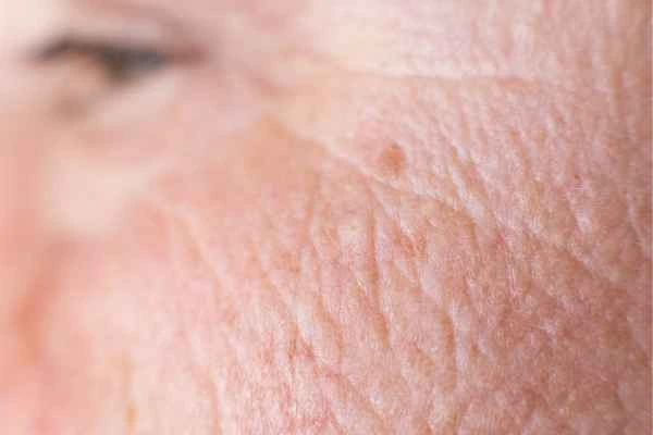 close up picture of a woman's face showing an age spot Greater London (Bexley)