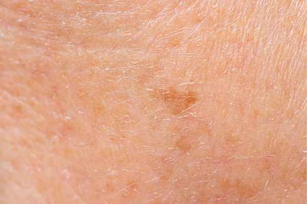 close up picture of age spots Greater London (Bexley)