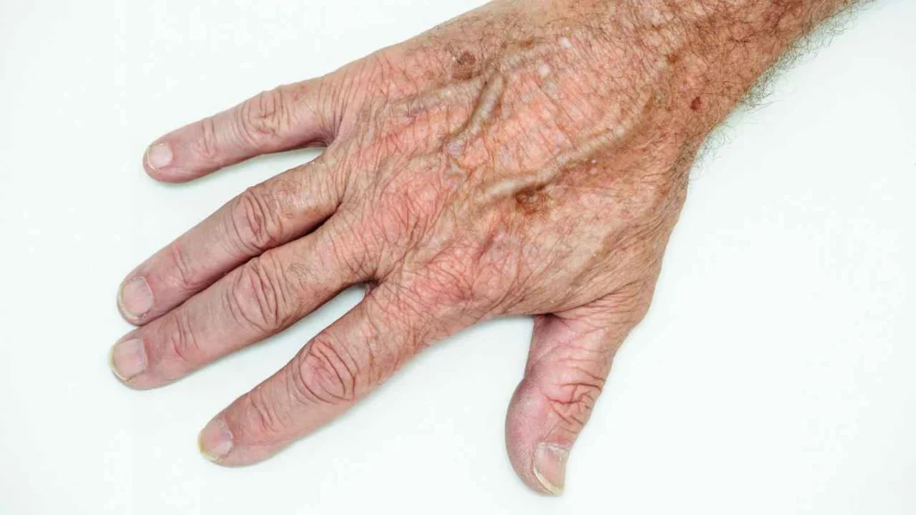 Male hand showing age spot Greater London (Bexley)