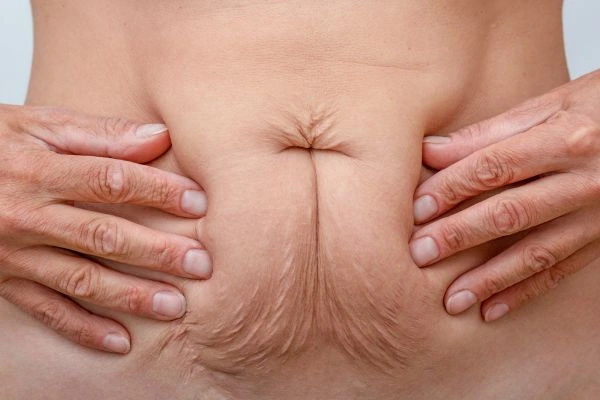 Image of a woman's stomach with loose skin - example of skin tightening Greater London (Bexley) options