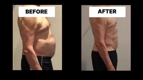 What Symptoms Can Diastasis Recti Cause in Men? Weak Core, Back Pain and Poor Posture Greater London (Bexley)